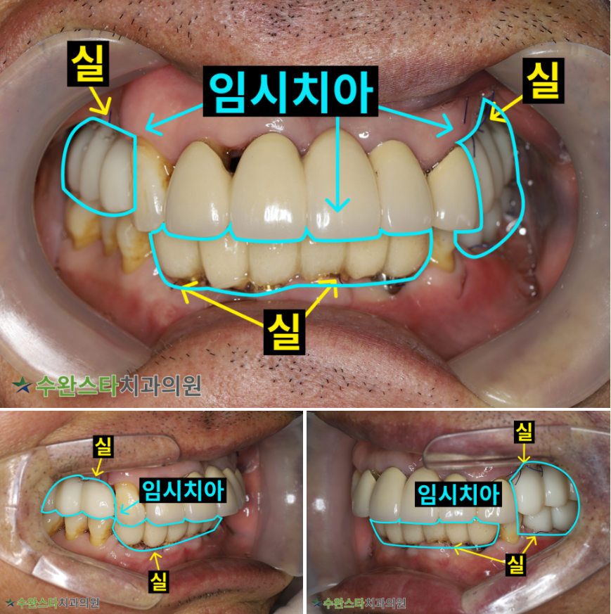 수술 2일 후 임시치아, 60대 남성 (2025. 11 촬영)