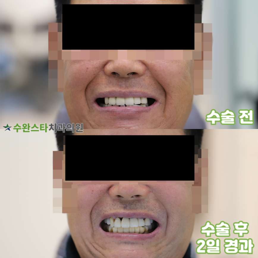 수술 전 / 수술 후 2일 경과, 60대 남성 (2025. 11 촬영)