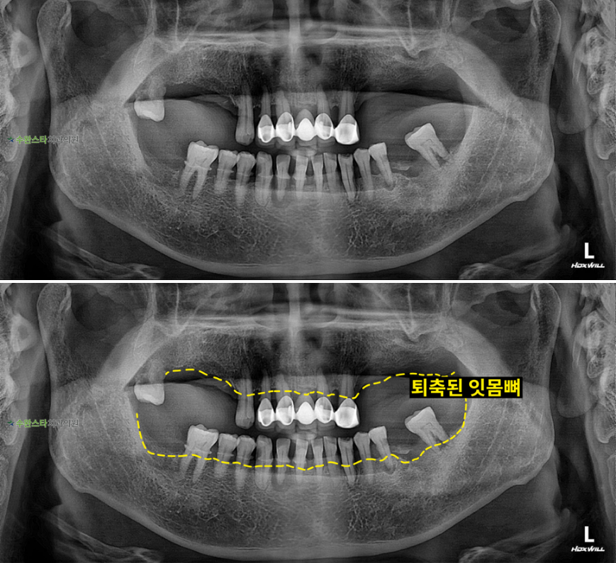 처음 내원 시 파노라마,  60대 남성 (2025. 11 촬영)  ​