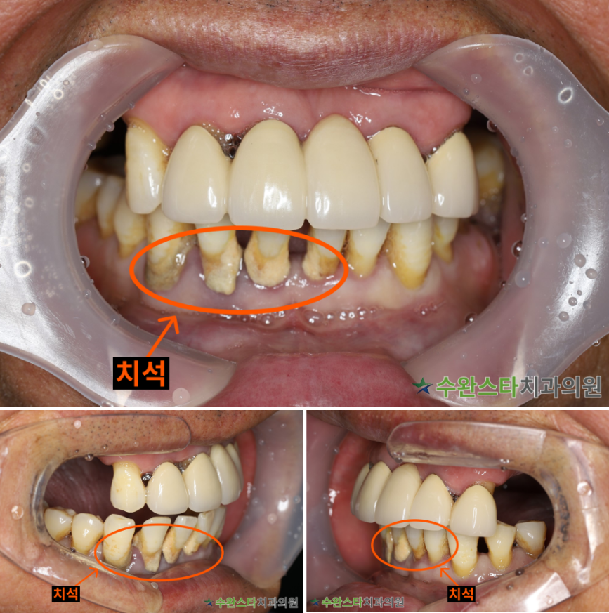 처음 내원 시 구강 내부 사진, 60대 남성 (2025. 11 촬영)