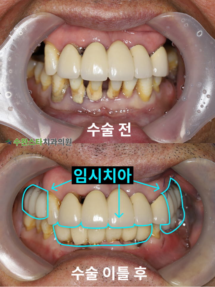 수술 전 / 수술 후 2일 구강 내부, 60대 남성 (2025. 11 촬영)  ​