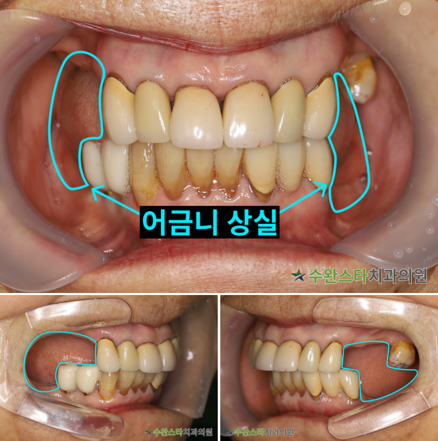 처음 내원 시 구강 내부 사진,  60대 여성 (2025. 12 촬영)