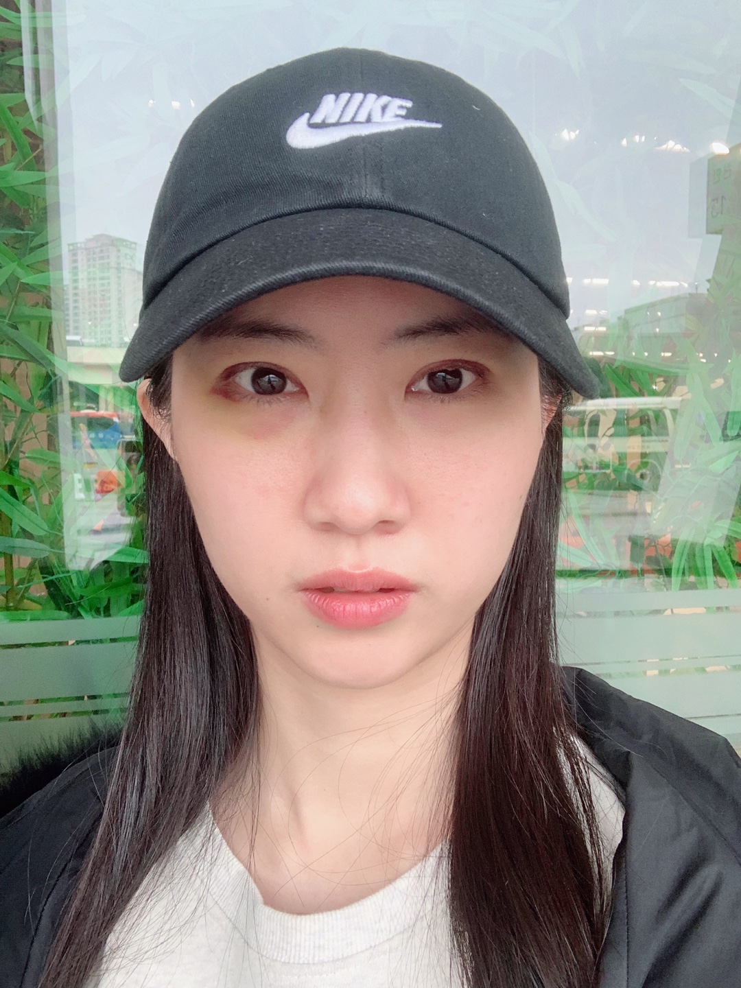 절개눈매교정재수술 1주일 후