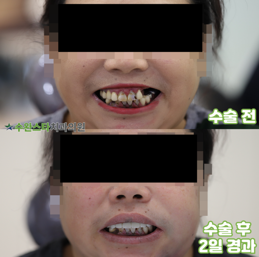 수술 전 / 수술 후 2일 경과, 50대 여성 (2025. 11 촬영)