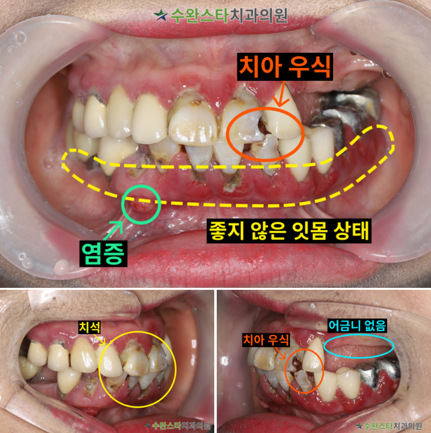 처음 내원 시 구강 내부 사진, 50대 여성 (2025. 11 촬영)