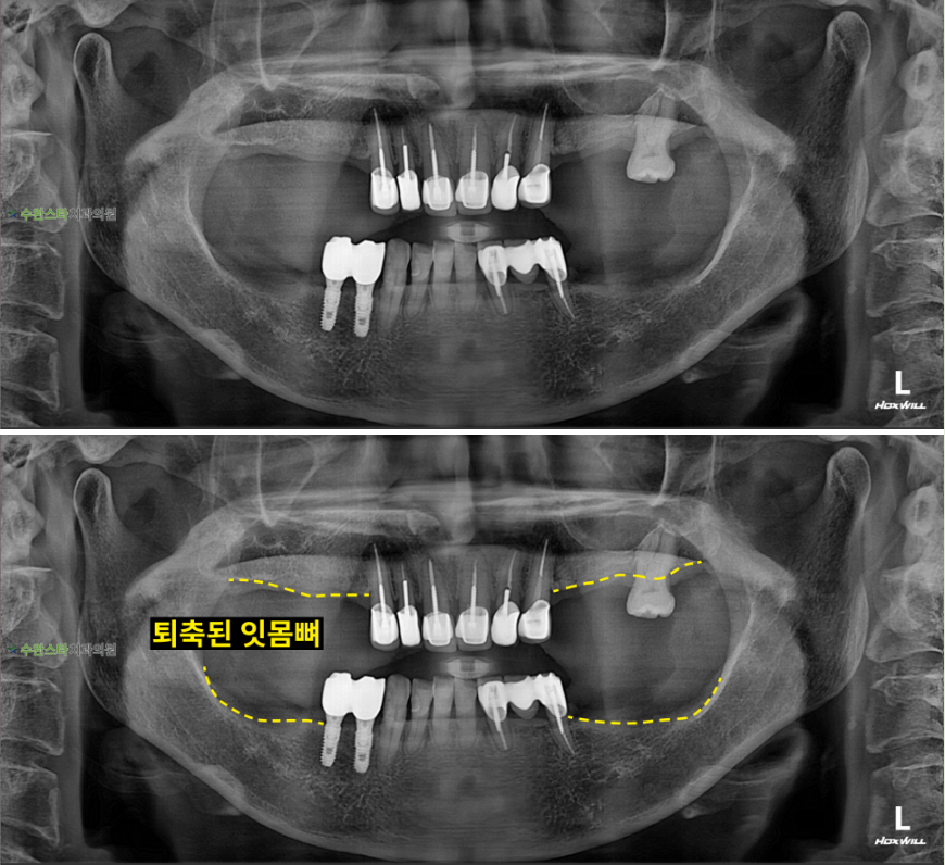 처음 내원 시 파노라마, 60대 여성 (2025. 12 촬영)