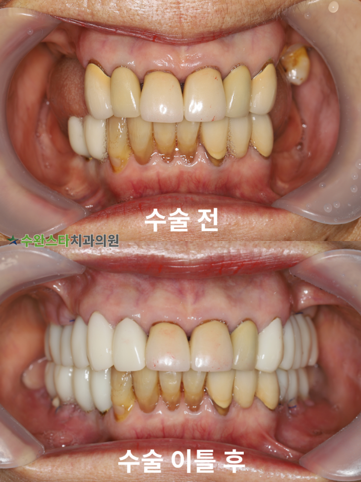 수술 전 / 수술 후 2일 구강 내부,  60대 여성 (2025. 12 촬영)