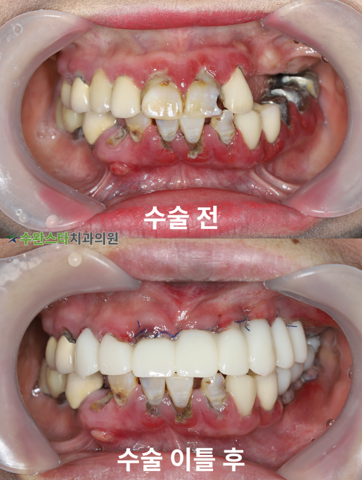 수술 전 / 수술 후 2일 구강 내부, 50대 여성 (2025. 11 촬영)