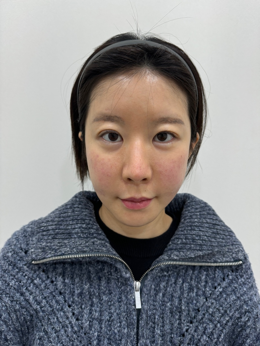 자연유착재수술 1개월 후