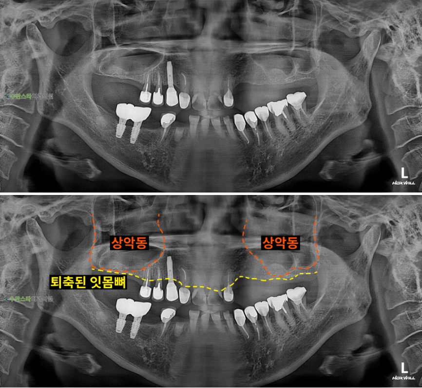 처음 내원 시 파노라마, 50대 여성 (2025. 11 촬영)  