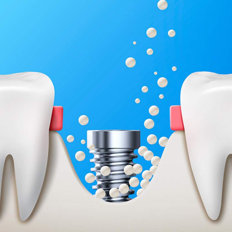 뼈이식 임플란트