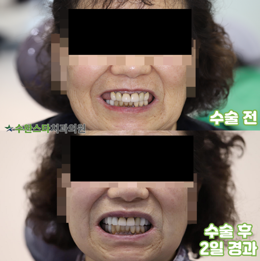 수술 전 / 수술 후 2일 경과,   60대 여성 (2025. 12 촬영)