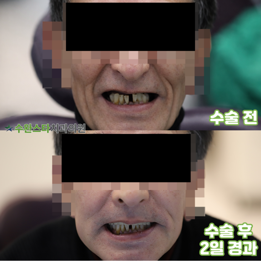 수술 전 / 수술 후 2일 경과, 60대 남성 (2025. 12 촬영)