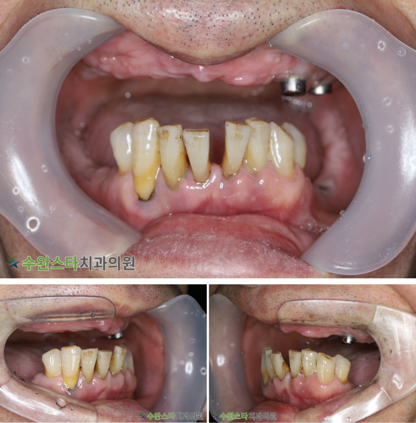 처음 내원 시 구강 내부 사진, 60대 남성 (2025. 12 촬영)