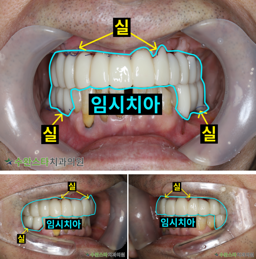 수술 2일 후 임시치아, 60대 남성 (2025. 12 촬영)