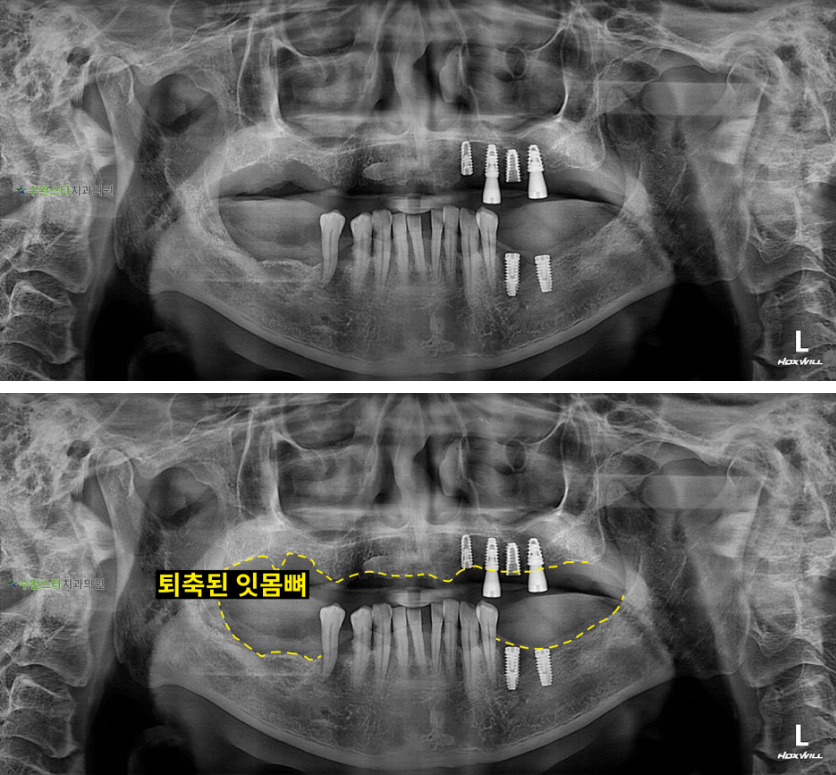 처음 내원 시 파노라마, 60대 남성 (2025. 12 촬영)