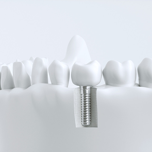 잇몸 절개 최소화