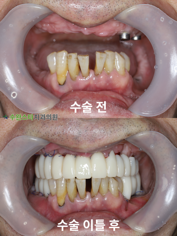 수술 전 / 수술 후 2일 구강 내부, 60대 남성 (2025. 12 촬영)