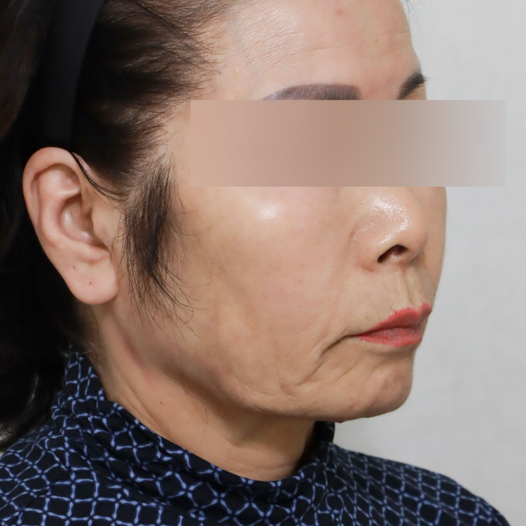 미니거상 before측면 이미지