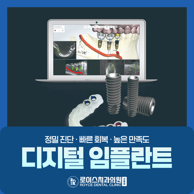 디지털 임플란트