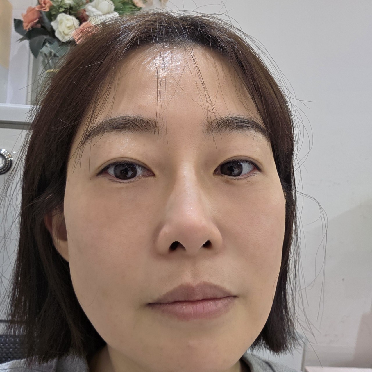 눈밑지방재배치 3개월 후