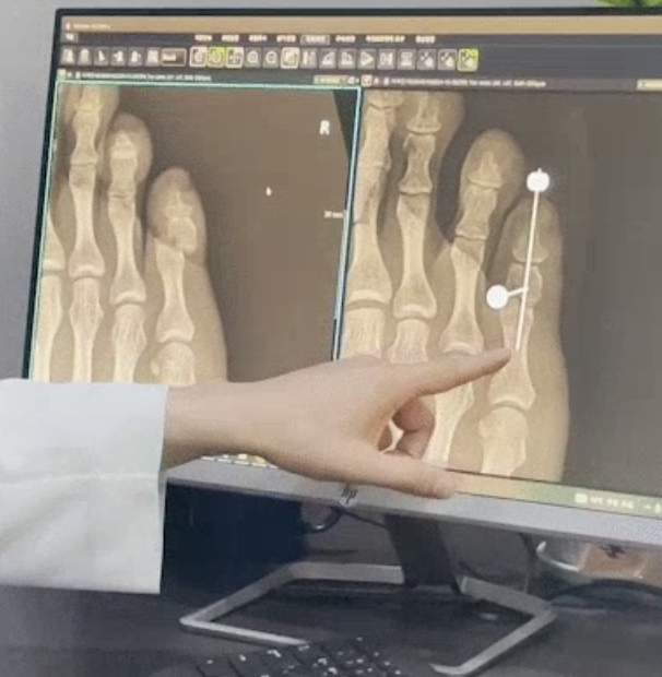 발목, 발가락 골절