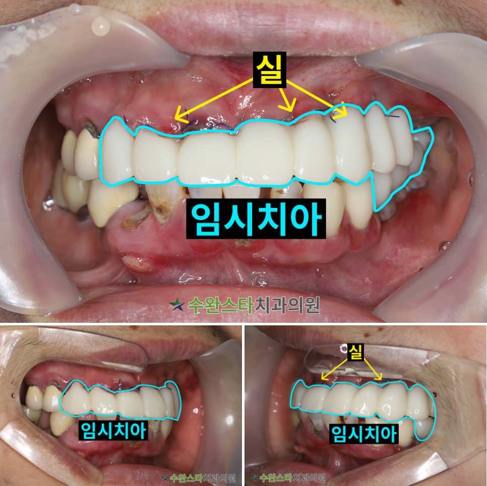 수술 2일 후 임시치아, 50대 여성 (2025. 11 촬영)