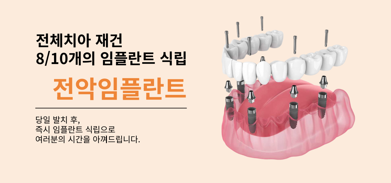 전체임플란트 가격