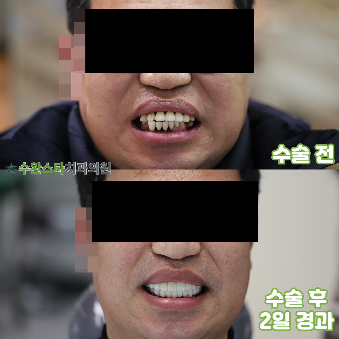 수술 전 / 수술 후 2일 경과, 50대 남성 (2026. 1 촬영)