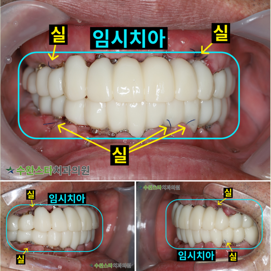 수술 2일 후 임시치아,  50대 남성 (2026. 1 촬영)  ​