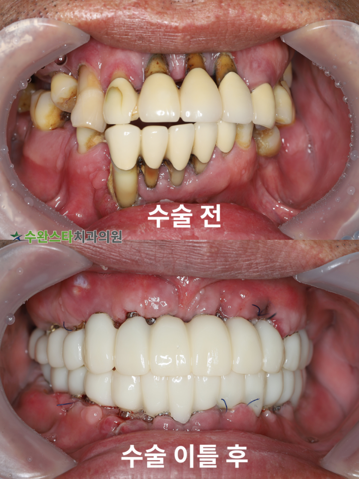 수술 전 / 수술 후 2일 구강 내부,  50대 남성 (2026. 1 촬영)