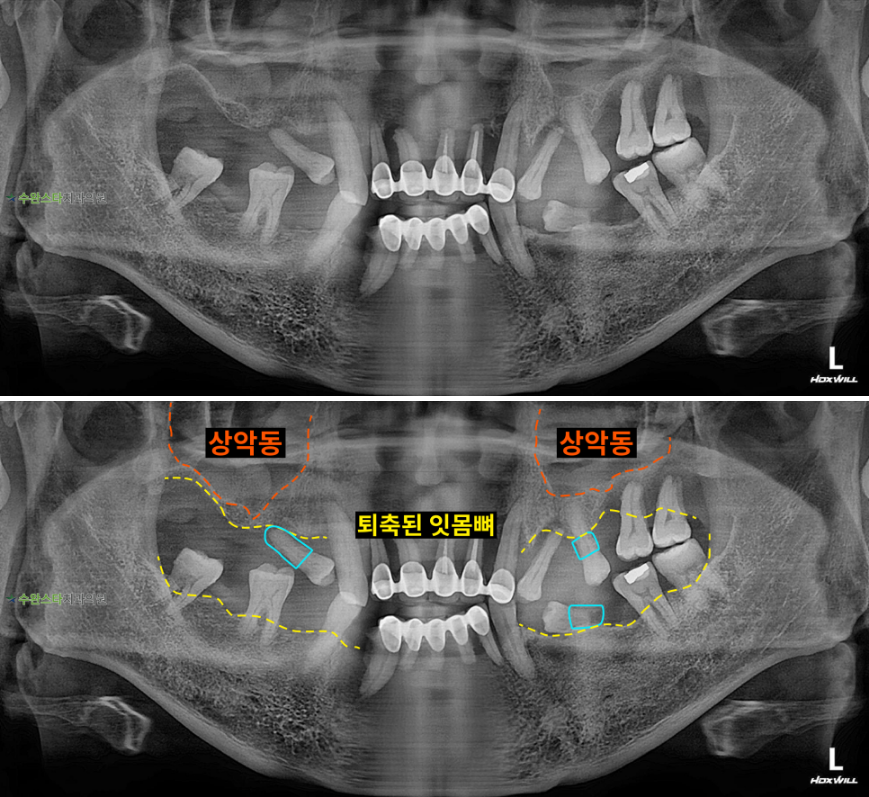 처음 내원 시 파노라마,  50대 남성 (2026. 1 촬영)