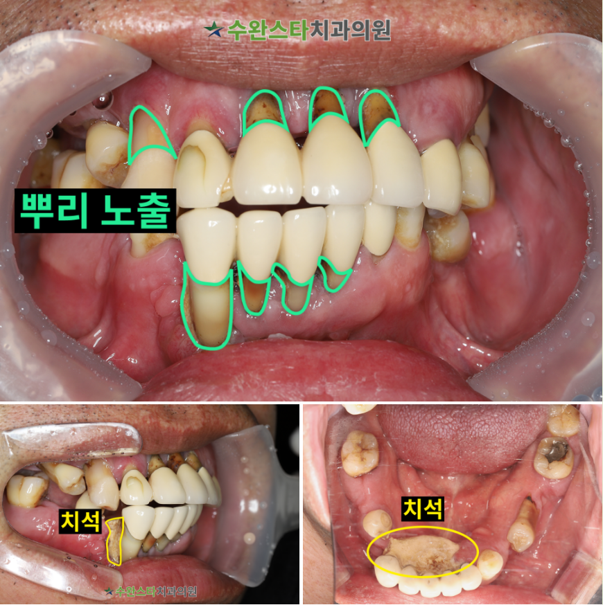 처음 내원 시 구강 내부 사진,  50대 남성 (2026. 1 촬영)  ​