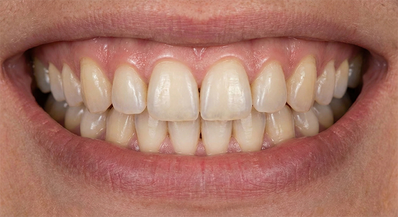 디지털아트치과 보존과 자연치아살리가