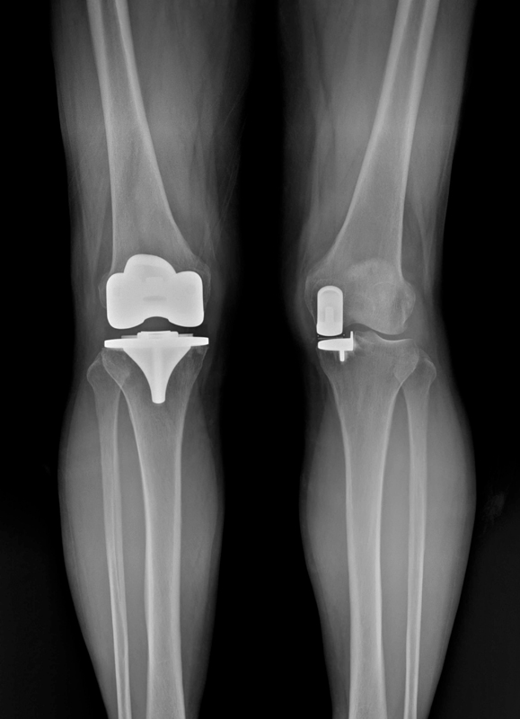 양주아산재건정형외과 전치환술 반치환술