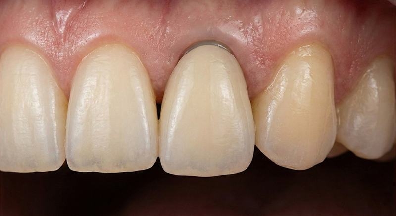 <style>      /* 폰트 불러오기 */      @import url("https://cdn.jsdelivr.net/gh/orioncactus/pretendard@v1.3.9/dist/web/static/pretendard.min.css");        .custom-desc-box {          display: block;          background-color: #78819F; /* 배경색 */          color: #FFFFFF;            /* 글자색 */          font-family: 'Pretendard', sans-serif;          font-size: 28px;          padding: 28px 35px;        /* 패딩 */                    box-sizing: border-box;          line-height: 1.4;                    /* ▼▼▼ 이 부분을 수정하세요 ▼▼▼ */          width: 100%;        /* 너비를 100%에서 줄여서 사진 안쪽으로 맞춤 (숫자 조절 가능) */          margin: 0 auto;    /* 박스를 가운데로 정렬 */          /* ▲▲▲▲▲▲▲▲▲▲▲▲▲▲▲▲▲▲▲▲▲▲▲ */            /* 위쪽 사진과 딱 붙게 하기 위해 위쪽 여백을 없앱니다 */          margin-top: -10px;       }</style><div class="custom-desc-box">      임플란트</div>