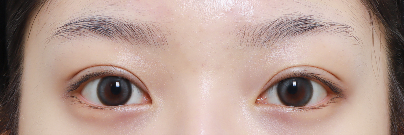 눈성형 After 정면