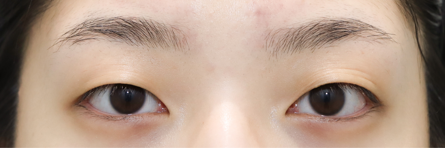 눈성형 Before 정면