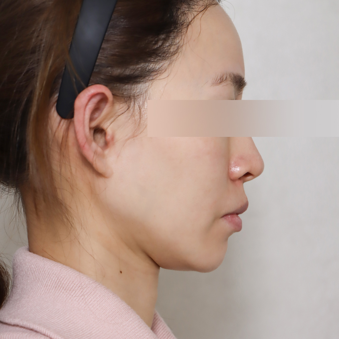 지방이식 Before 90도