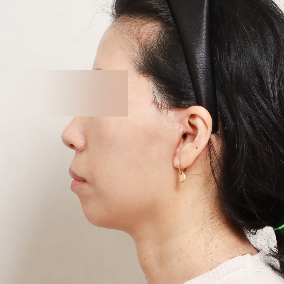 안면거상술 after 90도 이미지