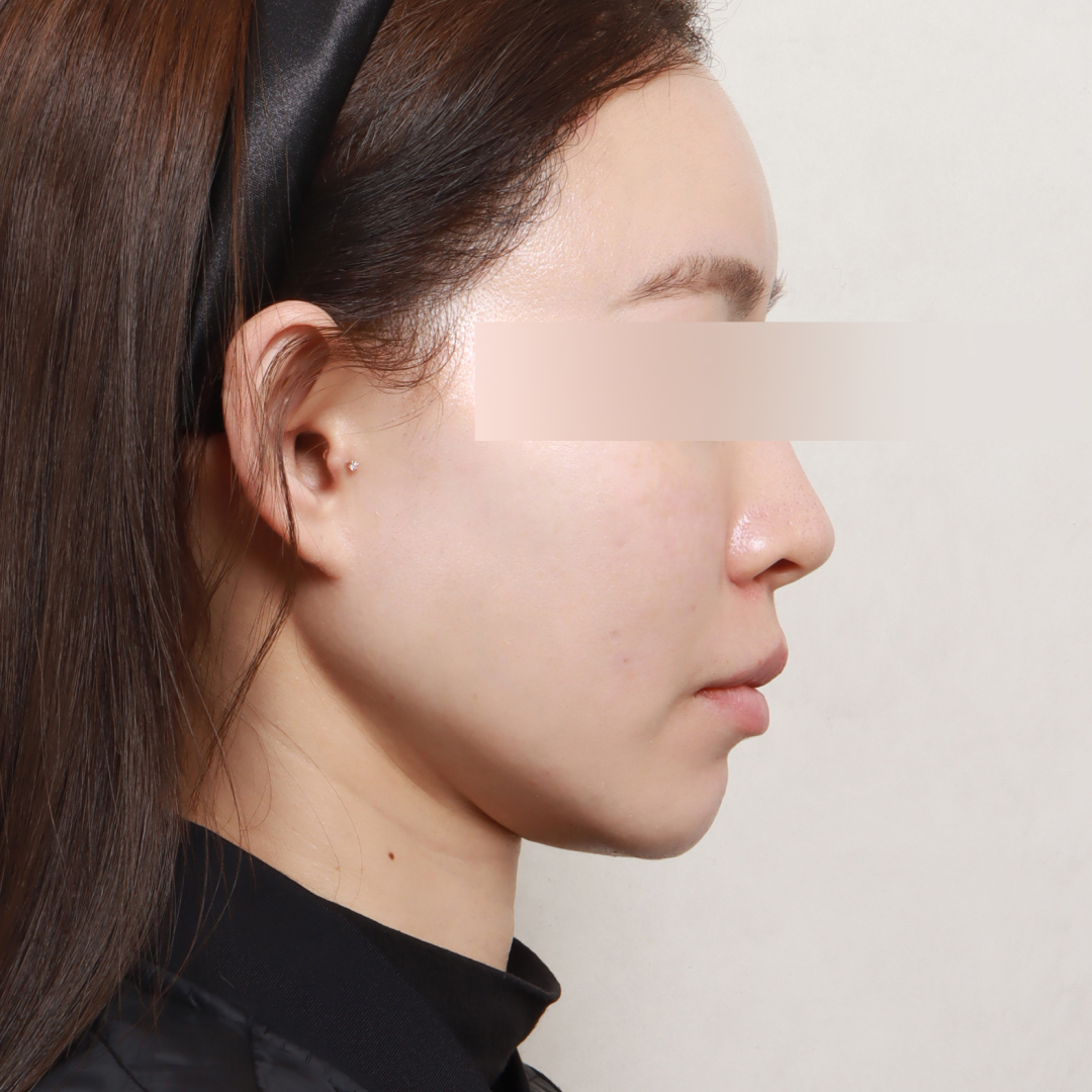 지방이식 After 90도