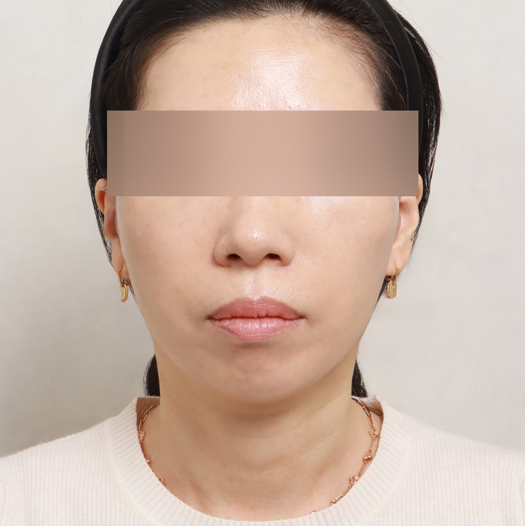 안면거상술 after정면 이미지
