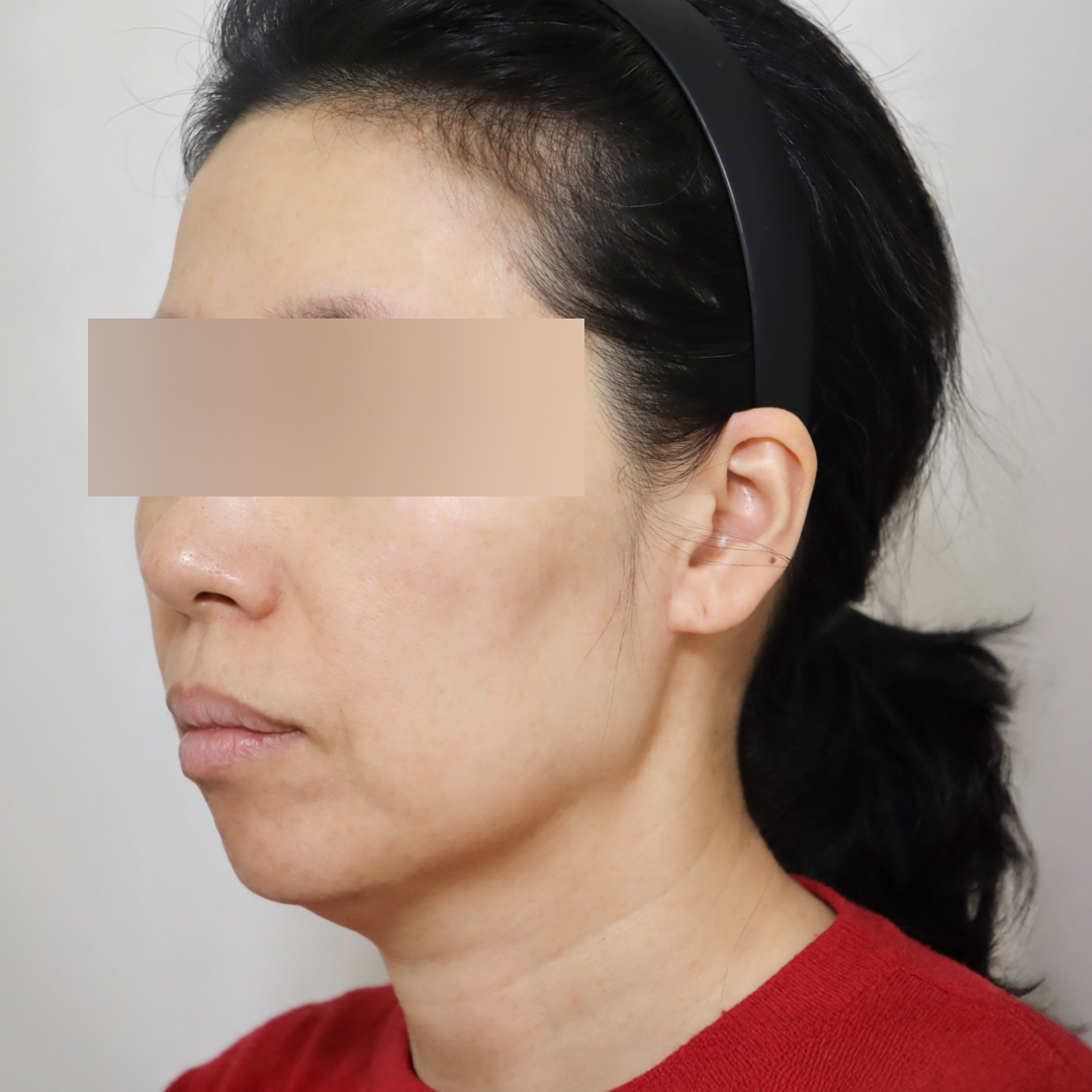 안면거상술 before측면 이미지