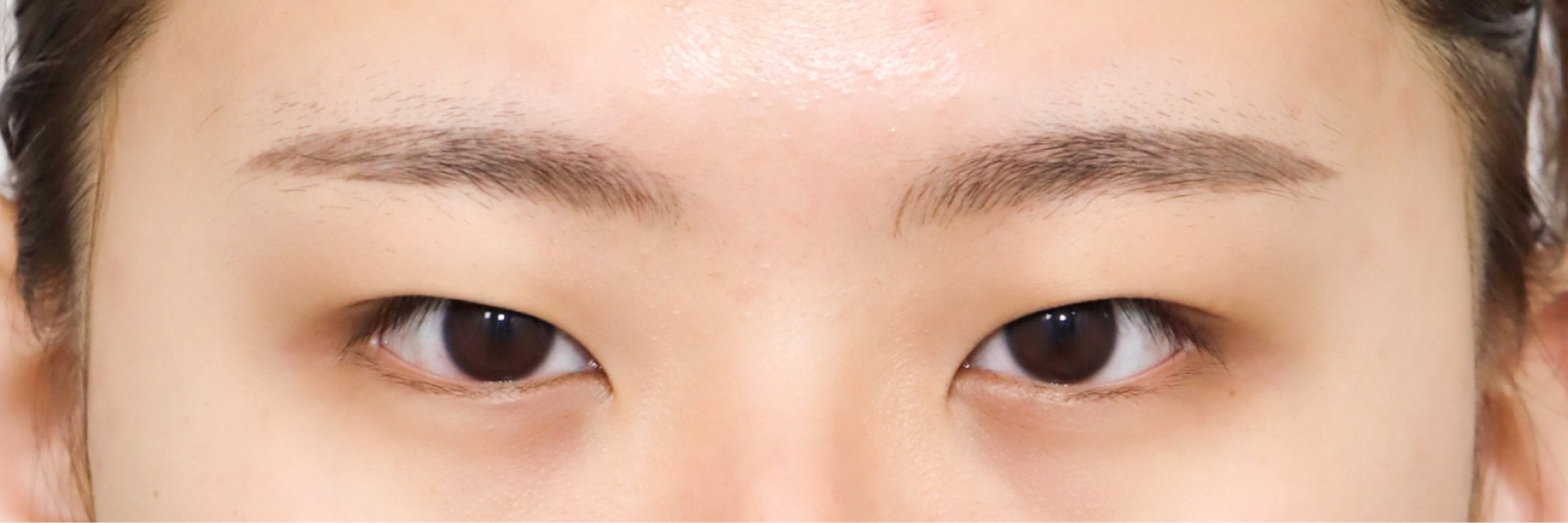 눈성형 Before 정면
