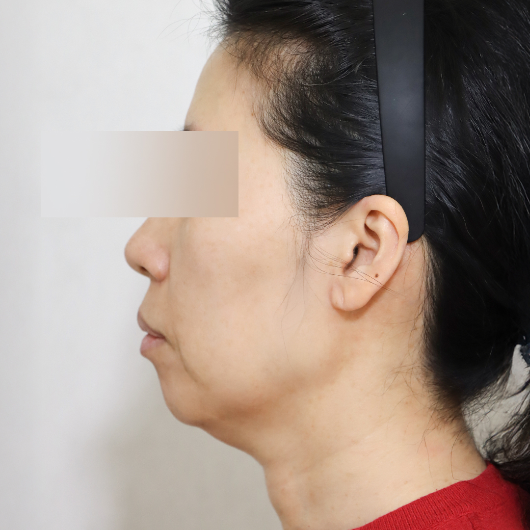 안면거상술 before 90도 이미지