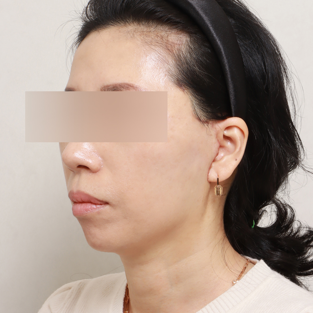 안면거상술 after측면 이미지