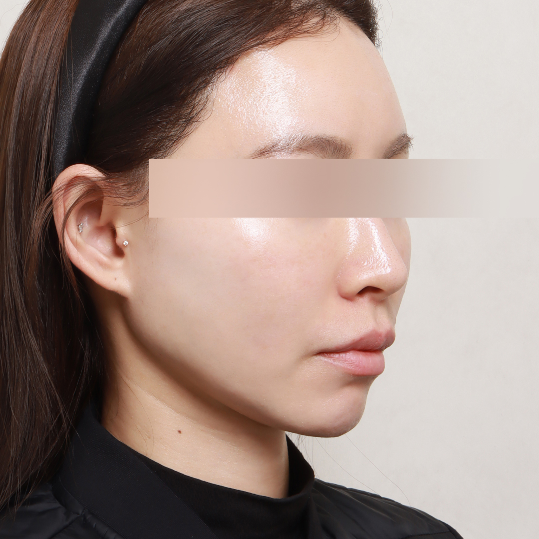 지방이식 After 정면