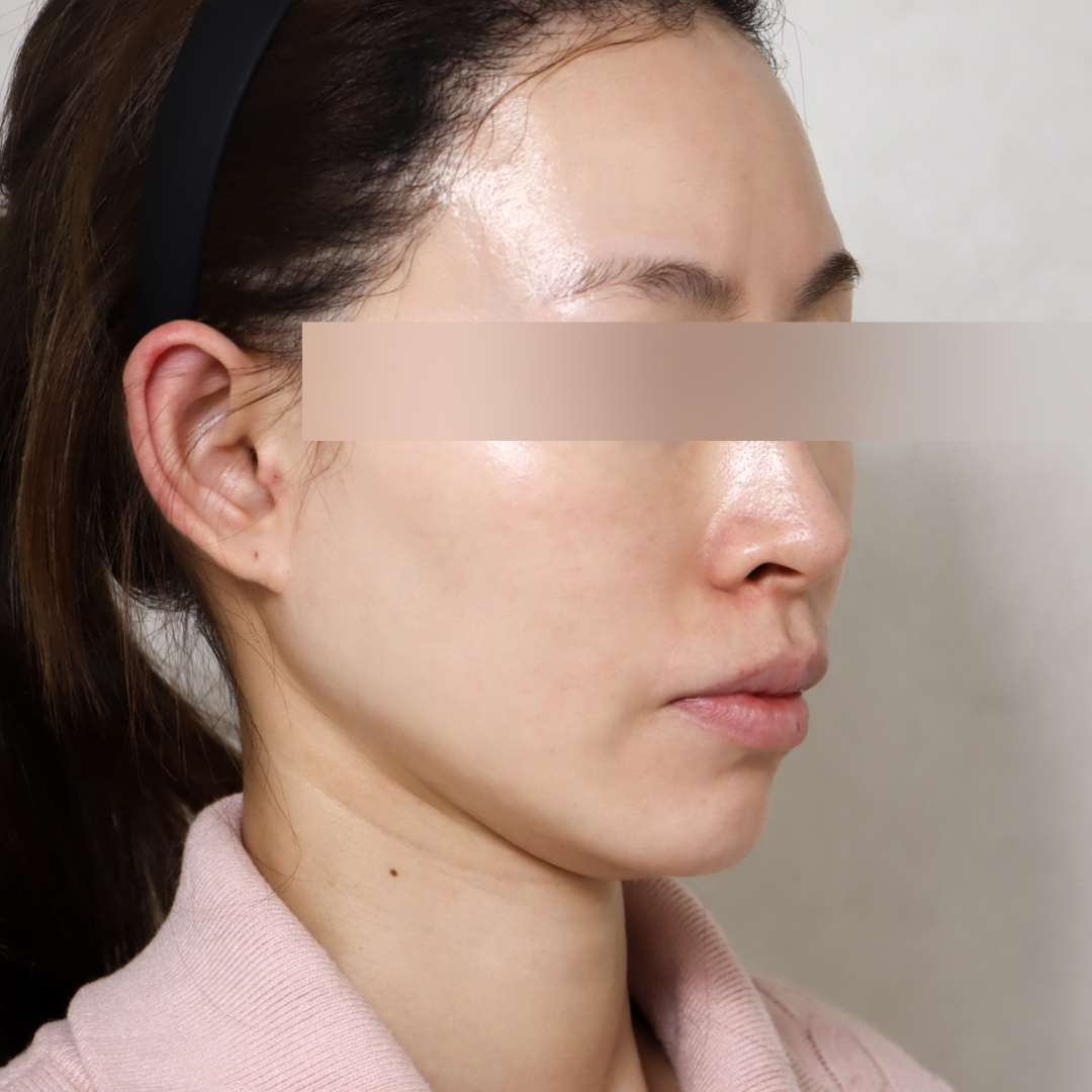 지방이식 Before 정면