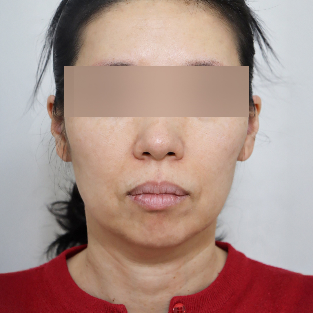 안면거상술 before정면 이미지