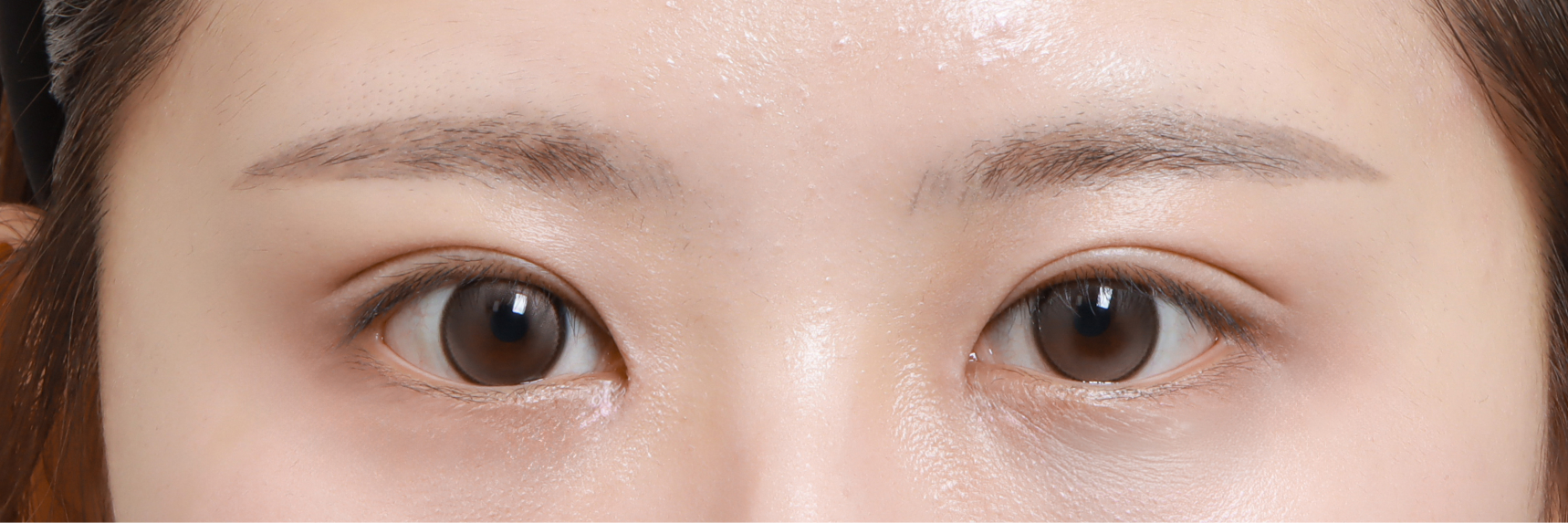 눈성형 After 정면